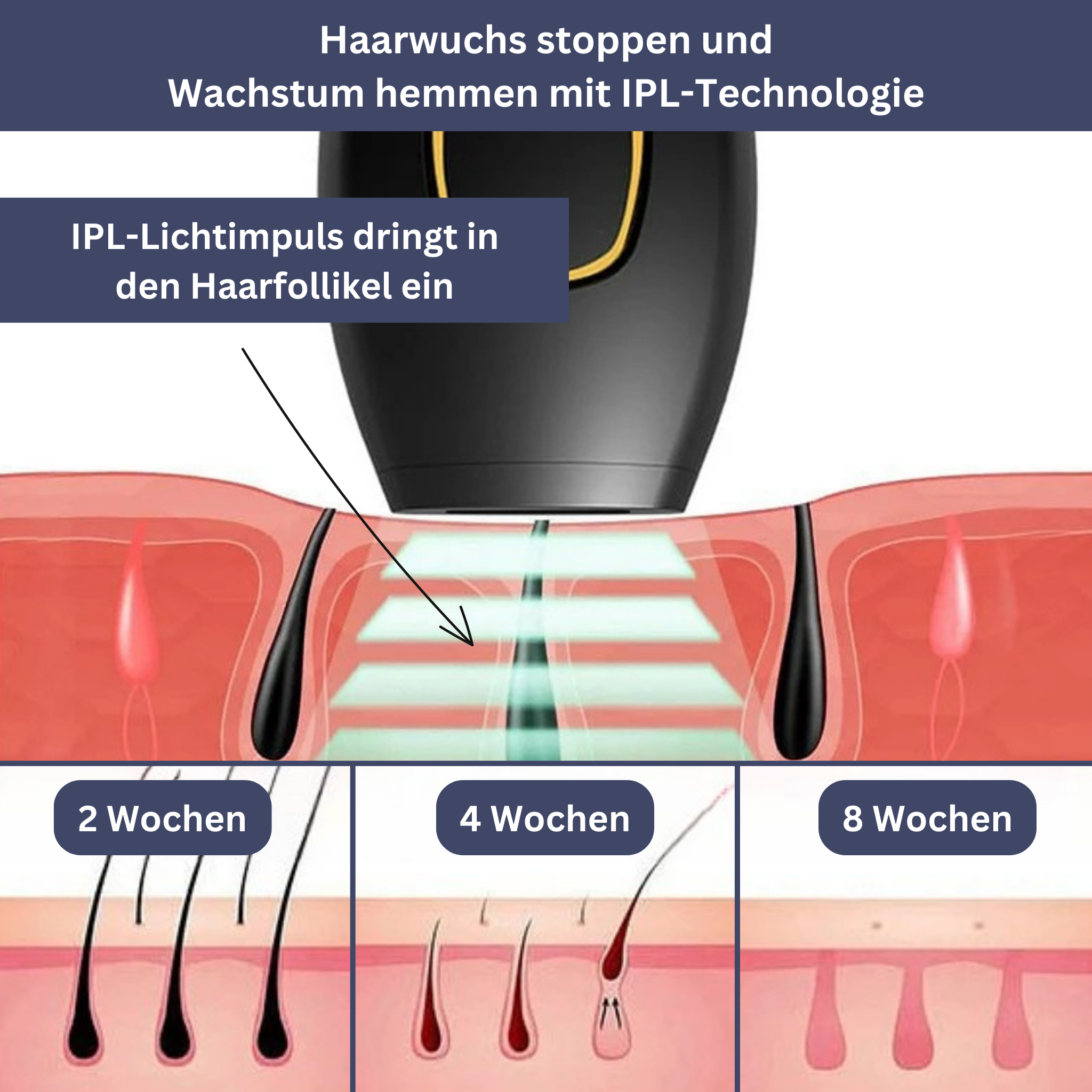 SmoothTouch IPL-ontharer