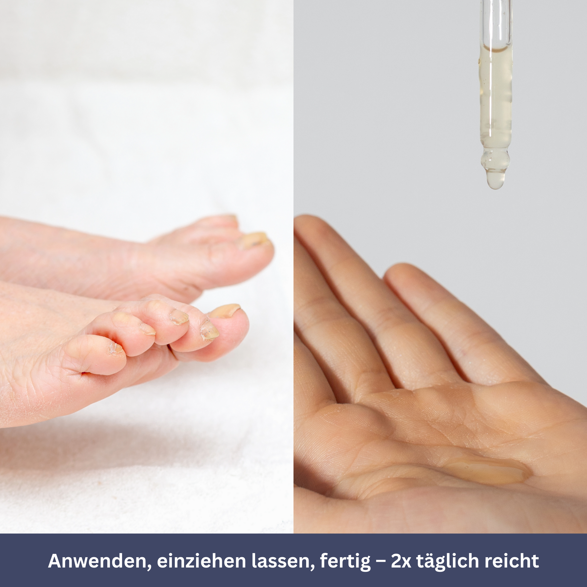 NailDrops – Verzorgend serum tegen schimmelnagels