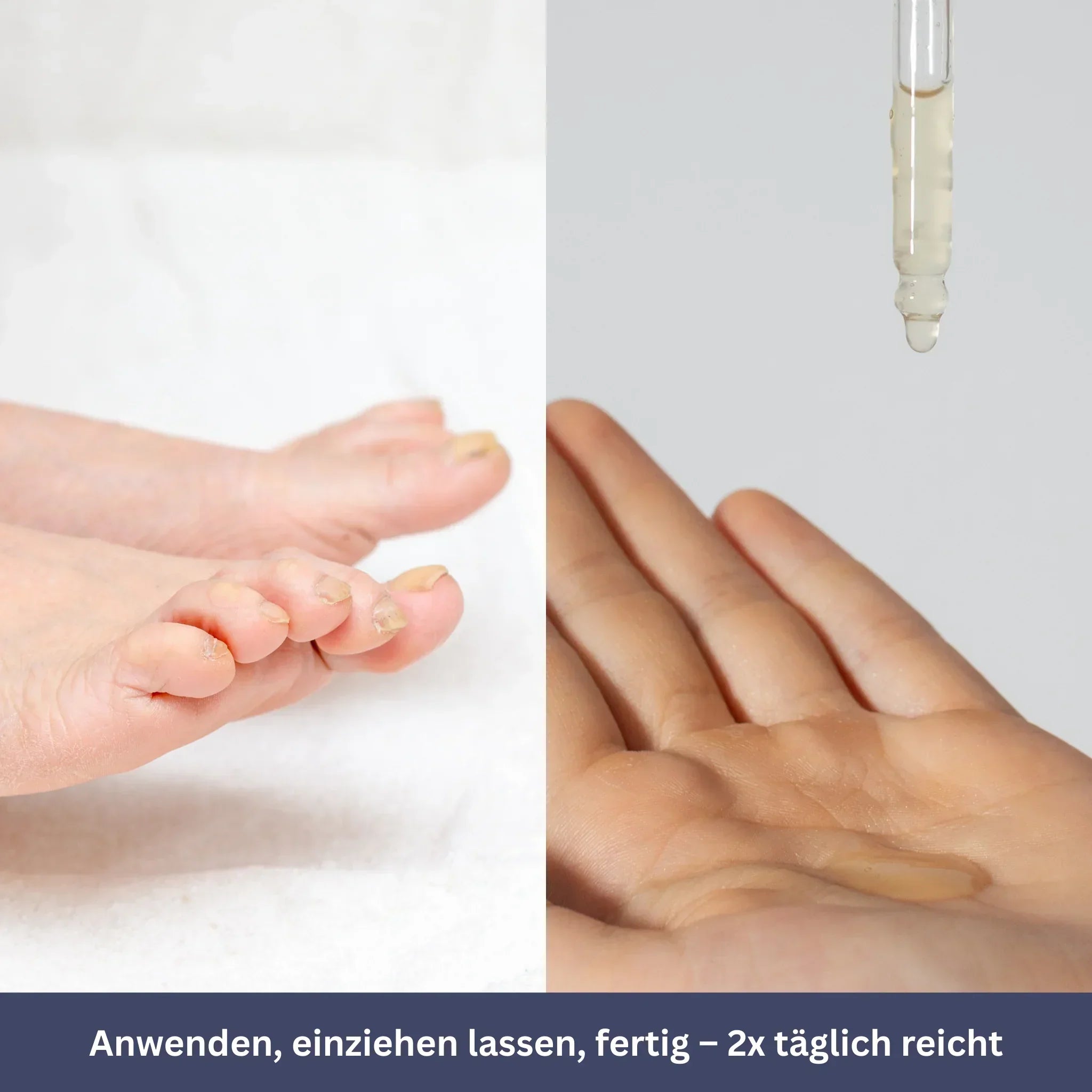 NailDrops – Verzorgend Serum tegen Schimmelnagels