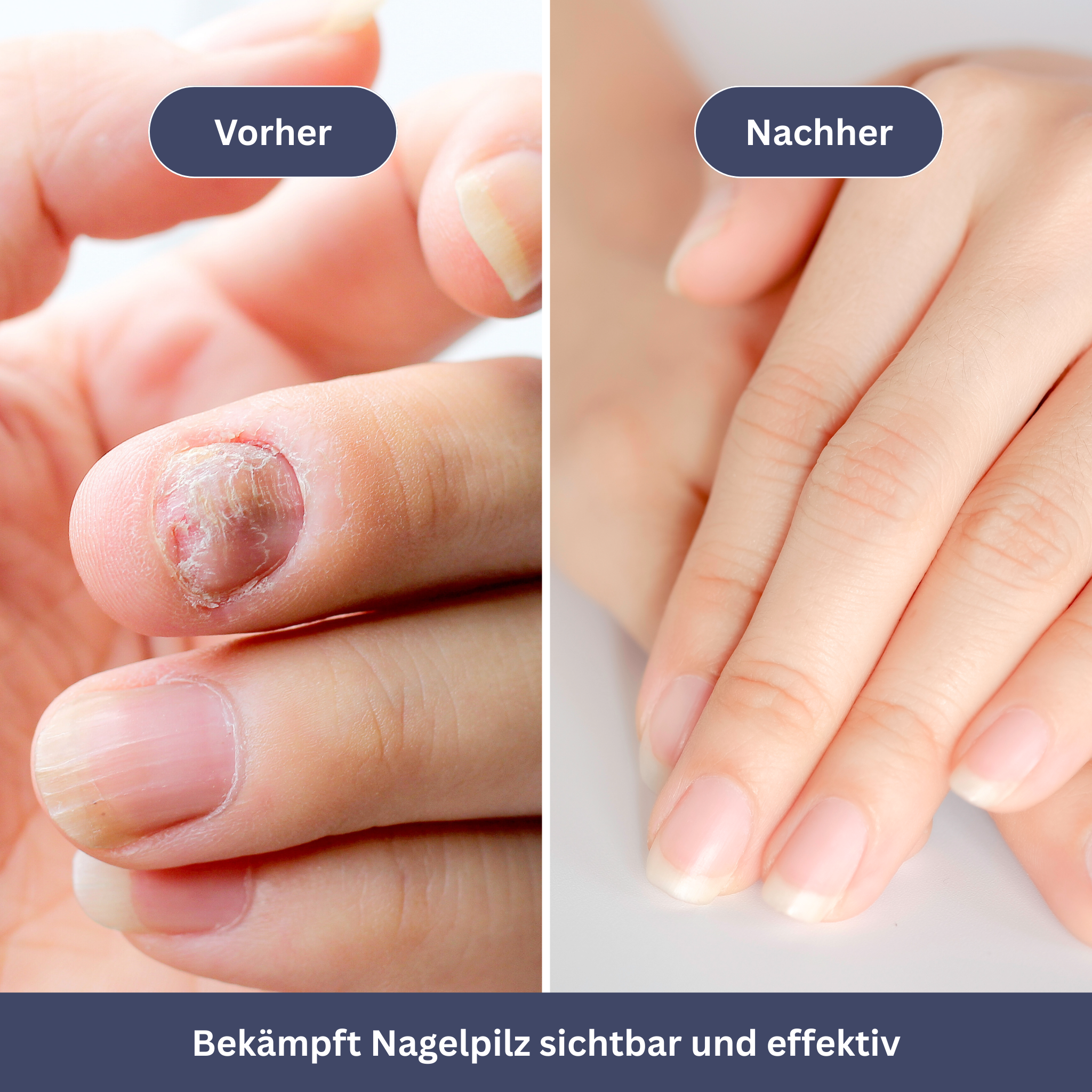 NailDrops – Verzorgend serum tegen schimmelnagels