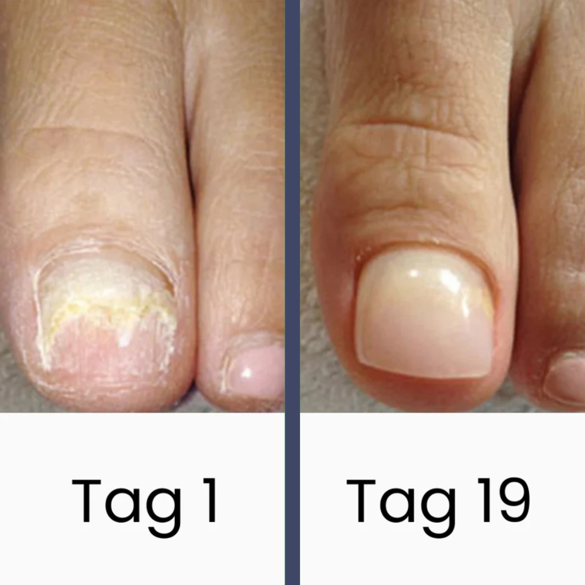 NailCare – Fungal Nail Treatment with UV Light