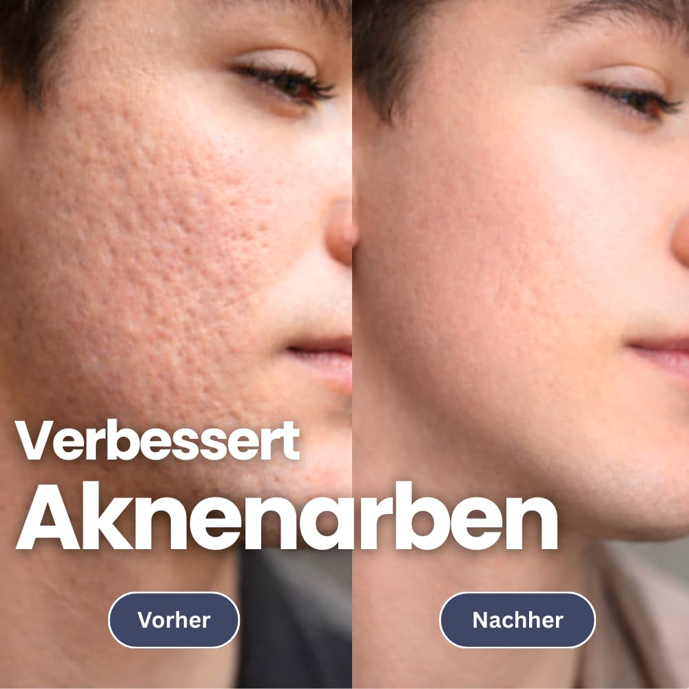 Microneedling infusieset voor een stevigere huid